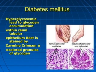 Diabetes mellitus
Hyperglycosemia
lead to glycogen
accumulation
within renal
tubular
epithelium Best is
stained by
Carmine Crimson ±
±colored granules
of glycogen

 