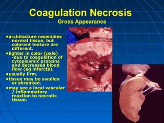 Coagulation Necrosis
Gross Appearance
•architecture resembles
normal tissue, but
colorant texture are
different.
•lighter in color (pale)
-due to coagulation of
cytoplasmic proteins
and decreased blood
flow (eg infarcts).
•usually firm.
•tissue may be swollen
or shrunken.
•may see a local vascular
/ inflammatory
reaction to necrotic
tissue.

 