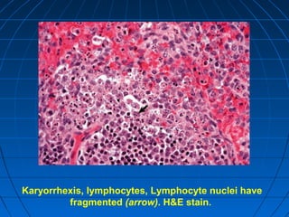 Karyorrhexis, lymphocytes, Lymphocyte nuclei have
fragmented (arrow). H&E stain.

 