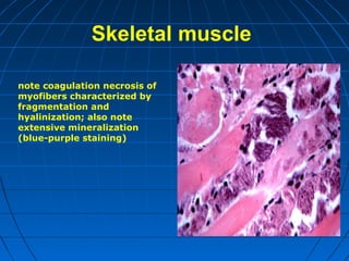 Skeletal muscle
note coagulation necrosis of
myofibers characterized by
fragmentation and
hyalinization; also note
extensive mineralization
(blue-purple staining)

 