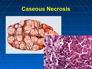 Caseous Necrosis

 