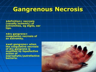 Gangrenous Necrosis
•definition= necrosis
(usually ischemic) of
extremities, eg digits, ear
tips.
•dry gangrene=
coagulation necrosis of
an extremity.
•wet gangrene= when
the coagulative necrosis
of dry gangrene is
modified by liquefactive
action of
saprophytic/putrefactive
bacteria.

 