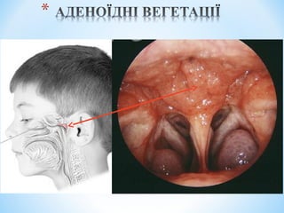 Гострі та хронічні захворювання глотки