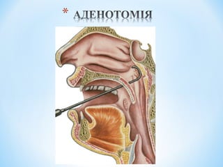 Гострі та хронічні захворювання глотки