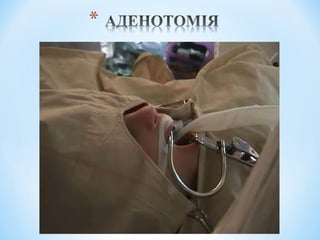 Гострі та хронічні захворювання глотки