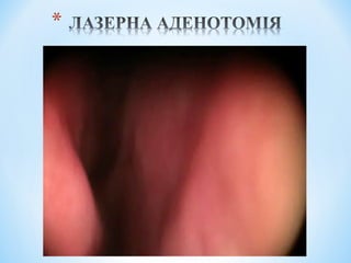 Гострі та хронічні захворювання глотки