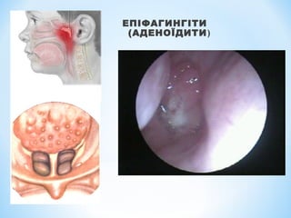 ЕПІФАГИНГІТИ
(АДЕНОЇДИТИ)

 