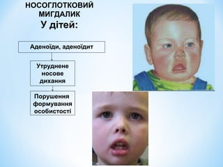 НОСОГЛОТКОВИЙ
МИГДАЛИК

У дітей:
Аденоїди, аденоїдит
Утруднене
носове
дихання
Порушення
формування
особистості

 