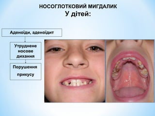 НОСОГЛОТКОВИЙ МИГДАЛИК

У дітей:
Аденоїди, аденоїдит
Утруднене
носове
дихання
Порушення
прикусу

 