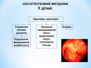 НОСОГЛОТКОВИЙ МИГДАЛИК

У дітей:
Аденоїди, аденоїдит
Утруднене
носове
дихання
Порушення
формування
особистості

Запальні
захворювання
носа і
додаткових
пазух,
глоткового
кільця

Енурез

 