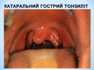 КАТАРАЛЬНИЙ ГОСТРИЙ ТОНЗИЛІТ

 