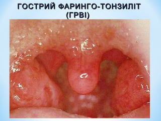 ГОСТРИЙ ФАРИНГО-ТОНЗИЛІТ
(ГРВІ)

 