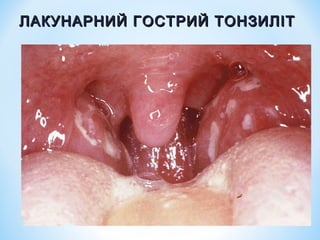 ЛАКУНАРНИЙ ГОСТРИЙ ТОНЗИЛІТ

 
