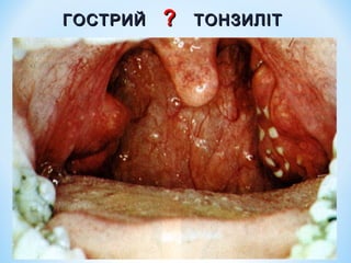 ГОСТРИЙ

?

ТОНЗИЛІТ

 