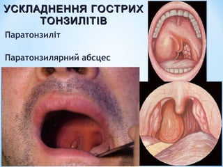 УСКЛАДНЕННЯ ГОСТРИХ
ТОНЗИЛІТІВ
Паратонзиліт
Паратонзилярний абсцес

 