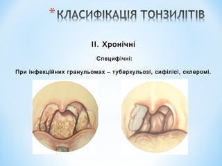 ІІ. Хронічні
Специфічні:
При інфекційних гранульомах – туберкульозі, сифілісі, склеромі.

 