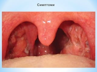 Симптоми

 