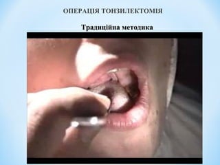 ОПЕРАЦІЯ ТОНЗИЛЕКТОМІЯ

Традиційна методика

 