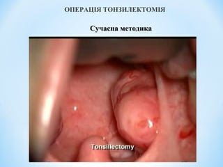 ОПЕРАЦІЯ ТОНЗИЛЕКТОМІЯ

Сучасна методика

 