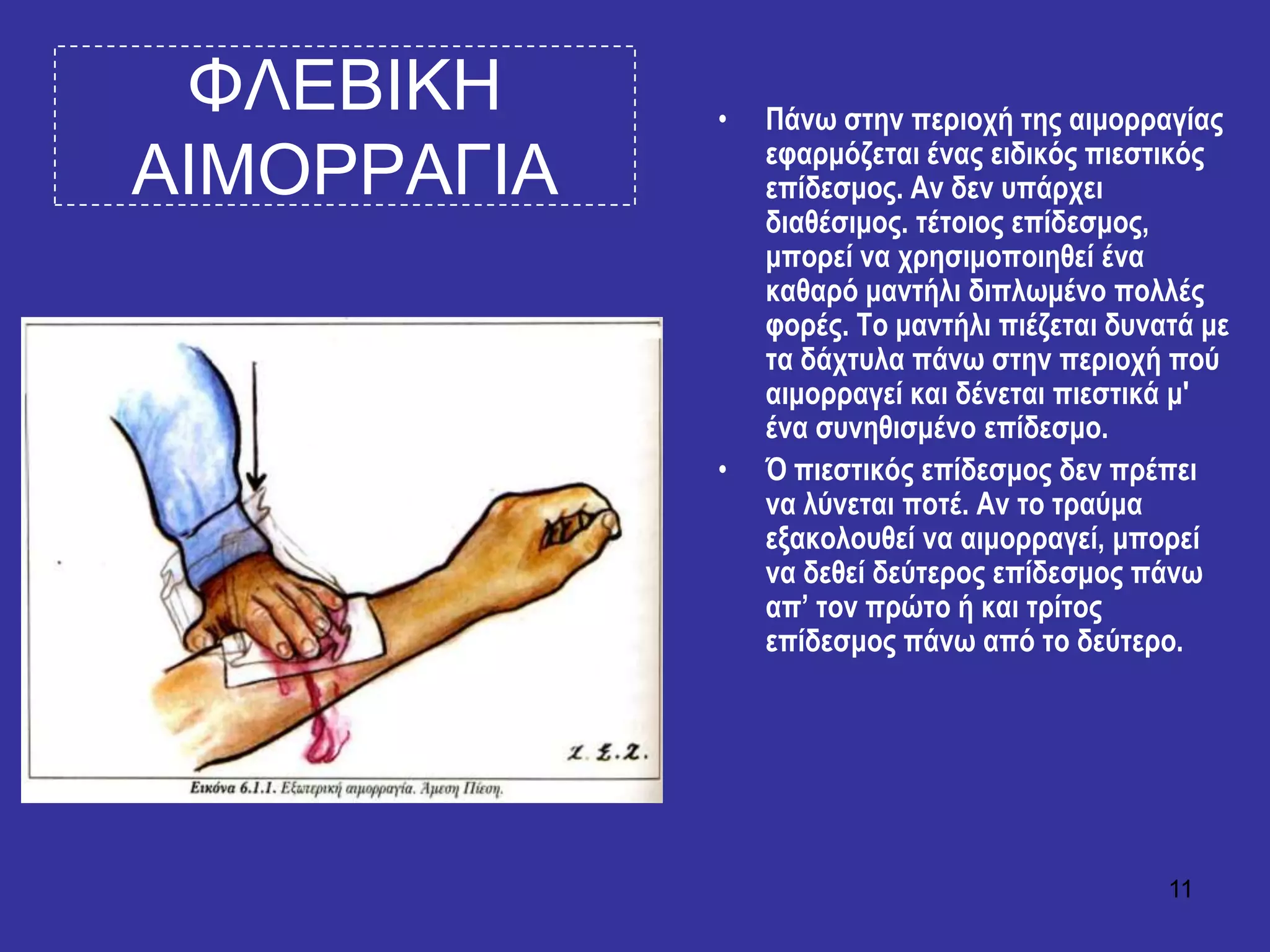 11
ΦΛΔΒΙΚΗ
ΑΙΜΟΡΡΑΓΙΑ
• Πάλσ ζηελ πεξηνρή ηεο αηκνξξαγίαο
εθαξκόδεηαη έλαο εηδηθόο πηεζηηθόο
επίδεζκνο. Αλ δελ ππάξρεη
δηαζέζηκνο. ηέηνηνο επίδεζκνο,
κπνξεί λα ρξεζηκνπνηεζεί έλα
θαζαξό καληήιη δηπισκέλν πνιιέο
θνξέο. Σν καληήιη πηέδεηαη δπλαηά κε
ηα δάρηπια πάλσ ζηελ πεξηνρή πνύ
αηκνξξαγεί θαη δέλεηαη πηεζηηθά κ'
έλα ζπλεζηζκέλν επίδεζκν.
• Ό πηεζηηθόο επίδεζκνο δελ πξέπεη
λα ιύλεηαη πνηέ. Αλ ην ηξαύκα
εμαθνινπζεί λα αηκνξξαγεί, κπνξεί
λα δεζεί δεύηεξνο επίδεζκνο πάλσ
απ’ ηνλ πξώην ή θαη ηξίηνο
επίδεζκνο πάλσ από ην δεύηεξν.
 