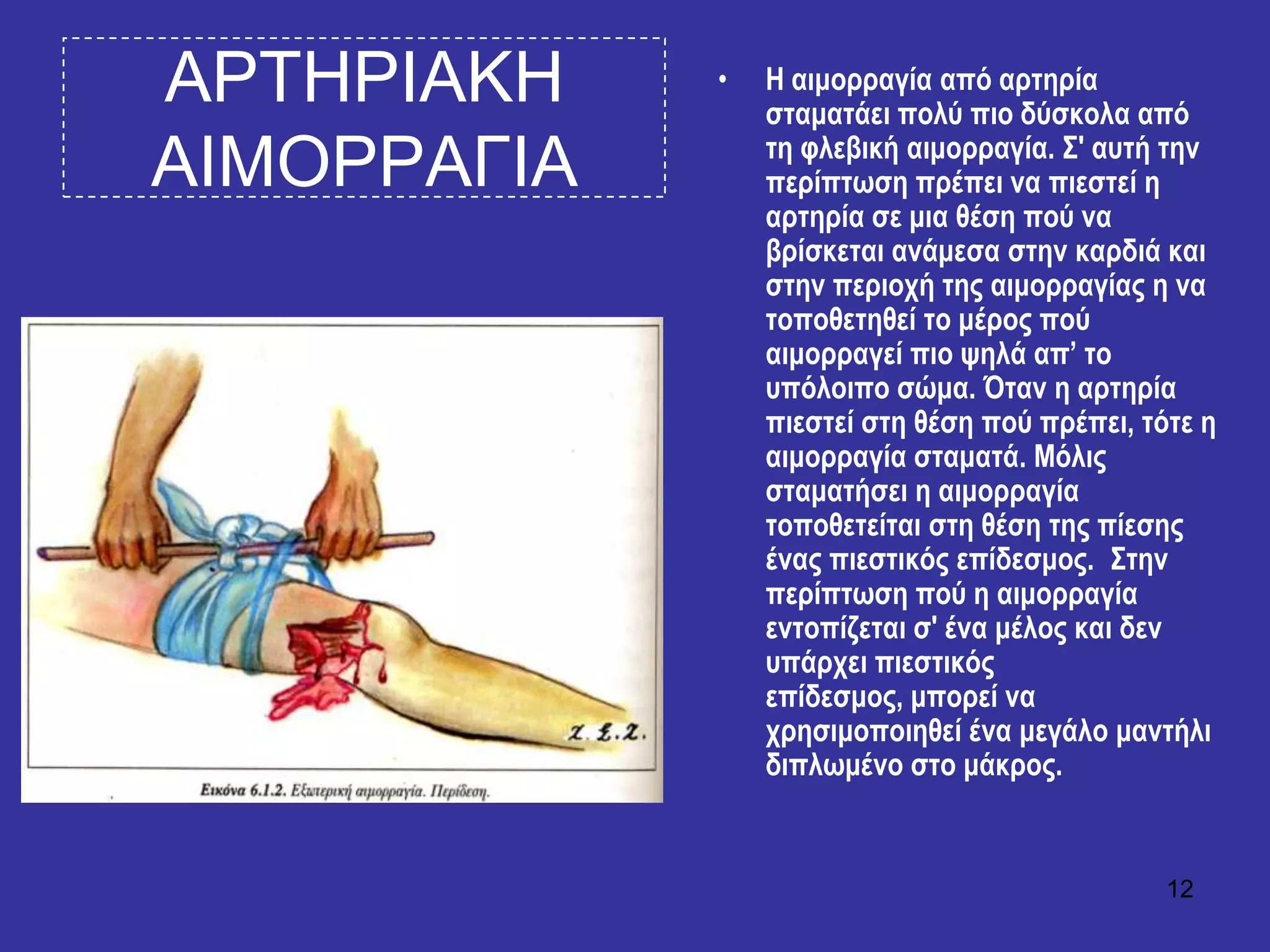 12
ΑΡΣΗΡΙΑΚΗ
ΑΙΜΟΡΡΑΓΙΑ
• H αηκνξξαγία από αξηεξία
ζηακαηάεη πνιύ πην δύζθνια από
ηε θιεβηθή αηκνξξαγία. ΢' απηή ηελ
πεξίπησζε πξέπεη λα πηεζηεί ε
αξηεξία ζε κηα ζέζε πνύ λα
βξίζθεηαη αλάκεζα ζηελ θαξδηά θαη
ζηελ πεξηνρή ηεο αηκνξξαγίαο ε λα
ηνπνζεηεζεί ην κέξνο πνύ
αηκνξξαγεί πην ςειά απ’ ην
ππόινηπν ζώκα. Όηαλ ε αξηεξία
πηεζηεί ζηε ζέζε πνύ πξέπεη, ηόηε ε
αηκνξξαγία ζηακαηά. Μόιηο
ζηακαηήζεη ε αηκνξξαγία
ηνπνζεηείηαη ζηε ζέζε ηεο πίεζεο
έλαο πηεζηηθόο επίδεζκνο. ΢ηελ
πεξίπησζε πνύ ε αηκνξξαγία
εληνπίδεηαη ζ' έλα κέινο θαη δελ
ππάξρεη πηεζηηθόο
επίδεζκνο, κπνξεί λα
ρξεζηκνπνηεζεί έλα κεγάιν καληήιη
δηπισκέλν ζην κάθξνο.
 