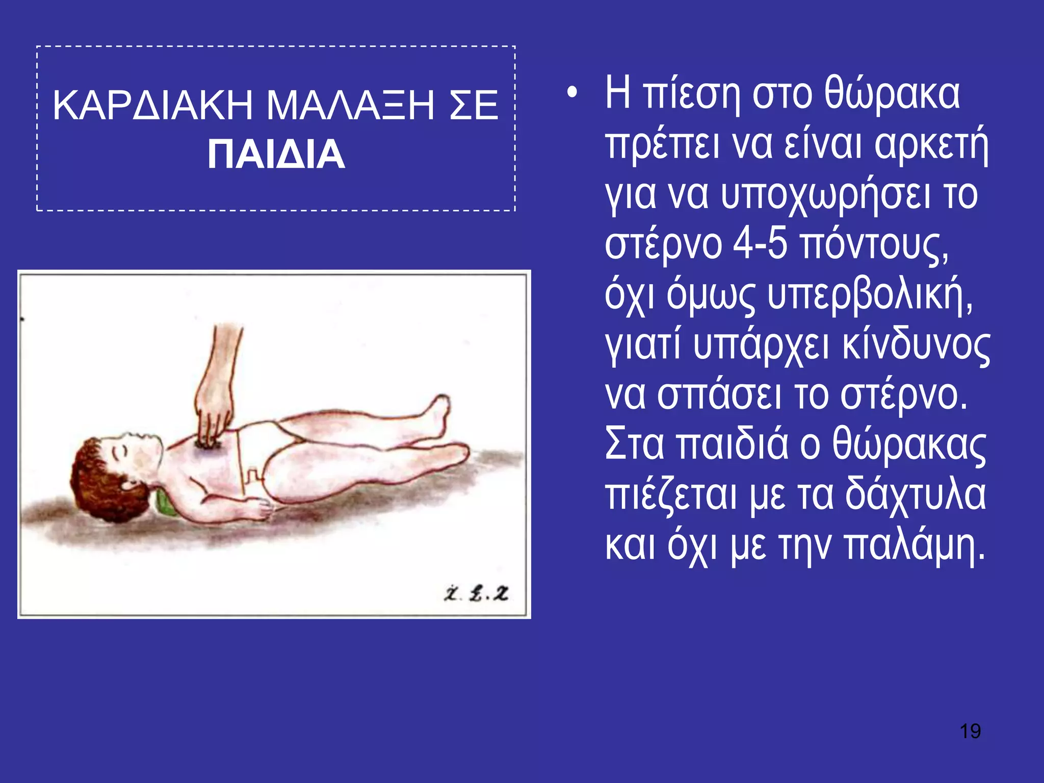 19
ΚΑΡΓΙΑΚΗ ΜΑΛΑΞΗ ΢Δ
ΠΑΙΓΙΑ
• Η πίεζε ζηο ζώραθα
πρέπεη λα είλαη αρθεηή
γηα λα σποτωρήζεη ηο
ζηέρλο 4-5 πόληοσς,
ότη όκως σπερβοιηθή,
γηαηί σπάρτεη θίλδσλος
λα ζπάζεη ηο ζηέρλο.
Σηα παηδηά ο ζώραθας
πηέδεηαη κε ηα δάτησια
θαη ότη κε ηελ παιάκε.
 