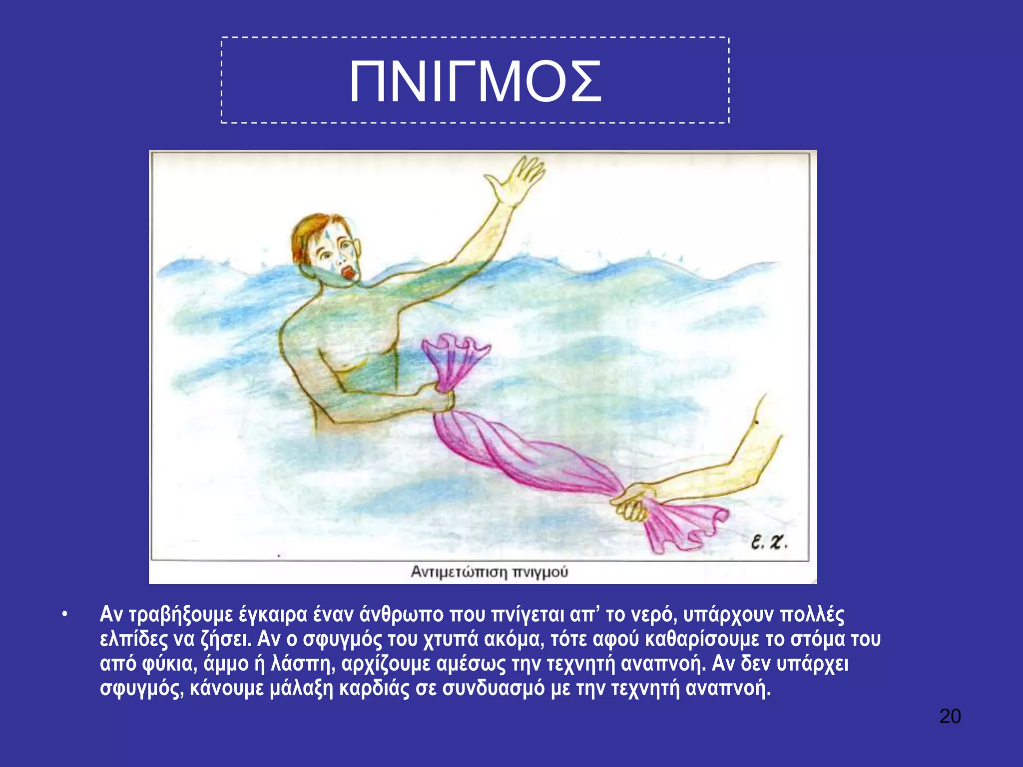 20
ΠΝΙΓΜΟ΢
• Αλ ηξαβήμνπκε έγθαηξα έλαλ άλζξσπν πνπ πλίγεηαη απ’ ην λεξό, ππάξρνπλ πνιιέο
ειπίδεο λα δήζεη. Αλ ν ζθπγκόο ηνπ ρηππά αθόκα, ηόηε αθνύ θαζαξίζνπκε ην ζηόκα ηνπ
από θύθηα, άκκν ή ιάζπε, αξρίδνπκε ακέζσο ηελ ηερλεηή αλαπλνή. Αλ δελ ππάξρεη
ζθπγκόο, θάλνπκε κάιαμε θαξδηάο ζε ζπλδπαζκό κε ηελ ηερλεηή αλαπλνή.
 