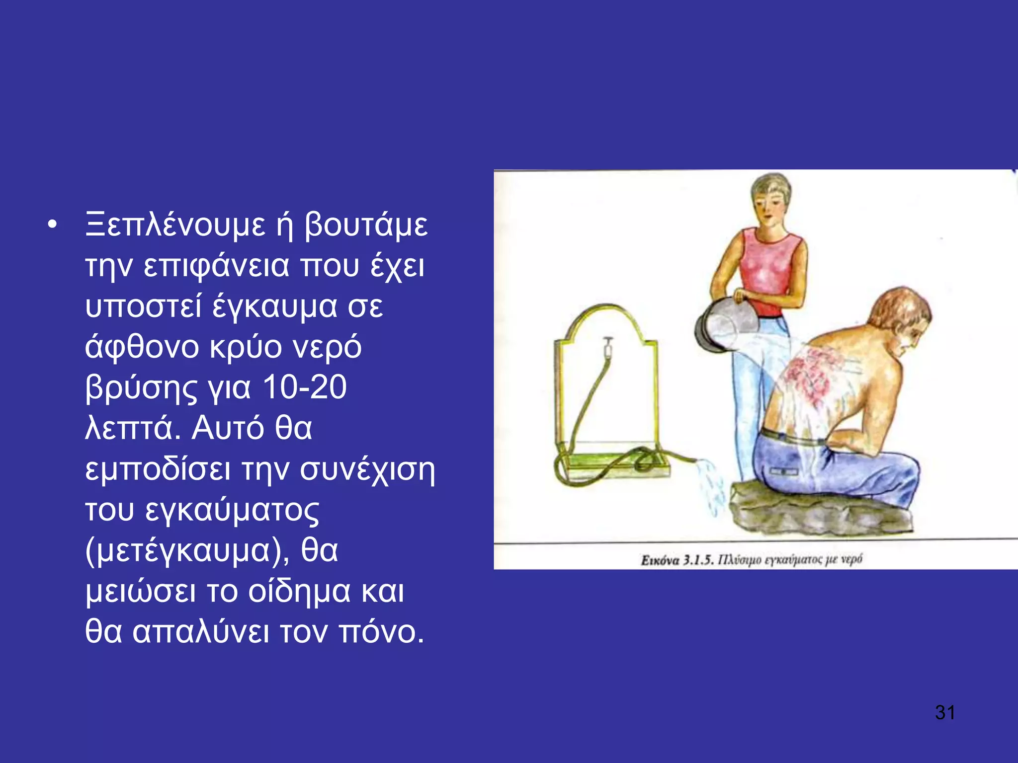 31
• Ξεπιέλνπκε ή βνπηάκε
ηελ επηθάλεηα πνπ έρεη
ππνζηεί έγθαπκα ζε
άθζνλν θξύν λεξό
βξύζεο γηα 10-20
ιεπηά. Απηό ζα
εκπνδίζεη ηελ ζπλέρηζε
ηνπ εγθαύκαηνο
(κεηέγθαπκα), ζα
κεηώζεη ην νίδεκα θαη
ζα απαιύλεη ηνλ πόλν.
 