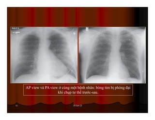 19-Jun-1311
AP view và PA view ở cùng một bệnh nhân: bóng tim bị phóng đại
khi chụp tư thế trước-sau.
 