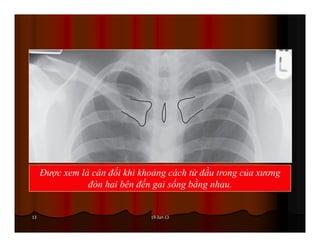 19-Jun-1313
Được xem là cân đối khi khoảng cách từ đầu trong của xương
đòn hai bên đến gai sống bằng nhau.
 