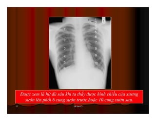 19-Jun-1317
Được xem là hít đủ sâu khi ta thấy được hình chiếu của xương
sườn lên phổi 6 cung sườn trước hoặc 10 cung sườn sau.
 