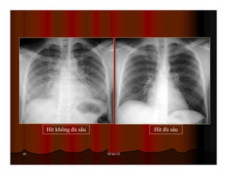 19-Jun-1318
Hít không đủ sâu Hít đủ sâu
 