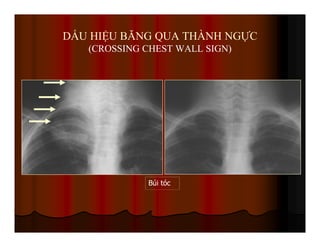 DẤU HIỆU BĂNG QUA THÀNH NGỰC
(CROSSING CHEST WALL SIGN)
Búi tóc
 