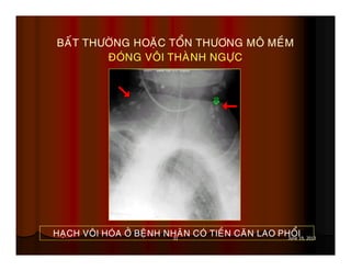 31 June 19, 2013
BAÁT THÖÔØNG HOAËC TOÅN THÖÔNG MOÂ MEÀM
ÑOÙNG VOÂI THAØNH NGÖÏC
HAÏCH VOÂI HOÙA ÔÛ BEÄNH NHAÂN COÙ TIEÀN CAÊN LAO PHOÅI
 