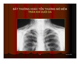 32 June 19, 2013
BAÁT THÖÔØNG HOAËC TOÅN THÖÔNG MOÂ MEÀM
TRAØN KHÍ DÖÔÙI DA
 