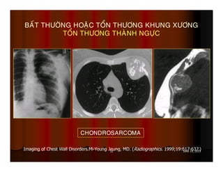 33 June 19, 2013
BAÁT THÖÔØNG HOAËC TOÅN THÖÔNG KHUNG XÖÔNG
TOÅN THÖÔNG THAØNH NGÖÏC
Imaging of Chest Wall Disorders.Mi-Young Jeung, MD. (Radiographics. 1999;19:617-637.)
CHONDROSARCOMA
 
