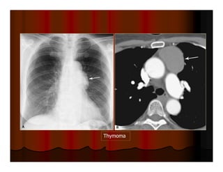 Thymoma
 