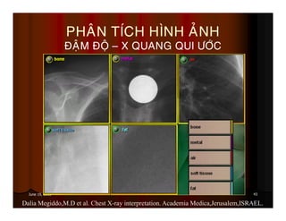 43June 19, 2013
PHAÂN TÍCH HÌNH AÛNH
ÑAÄM ÑOÄ – X QUANG QUI ÖÔÙC
Dalia Megiddo,M.D et al. Chest X-ray interpretation. Academia Medica,Jerusalem,ISRAEL.
 