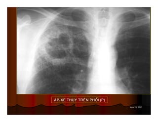 June 19, 2013
AÙP-XE THUØY TREÂN PHOÅI (P)
 