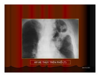 June 19, 2013
AÙP-XE THUØY TREÂN PHOÅI (T)
 