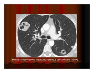 Female: cavitary lesions, metastatic squamous cell carcinoma (cervix).
 