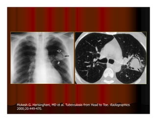 Mukesh G. Harisinghani, MD et al. Tuberculosis from Head to Toe. Radiographics.
2000;20:449-470.
 