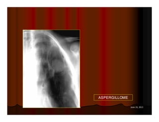 76 June 19, 2013
ASPERGILLOME
 