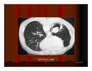 77 June 19, 2013
ASPERGILLOME
 