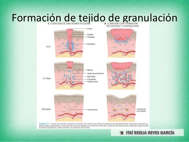 2. curacion mediante reparacion, formación de cicatrices y fibrosis e…