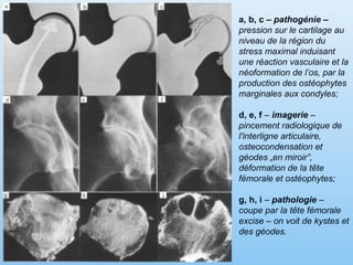 a, b, c – pathogénie –
pression sur le cartilage au
niveau de la région du
stress maximal induisant
une réaction vasculaire et la
néoformation de l’os, par la
production des ostéophytes
marginales aux condyles;
d, e, f – imagerie –
pincement radiologique de
l'interligne articulaire,
osteocondensation et
géodes „en miroir”,
déformation de la tête
fémorale et ostéophytes;
g, h, i – pathologie –
coupe par la tête fémorale
excise – on voit de kystes et
des géodes.
 