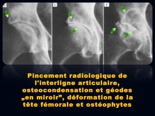 Pincement radiologique de
l'interligne articulaire,
osteocondensation et géodes
„en miroir”, déformation de la
tête fémorale et ostéophytes
 