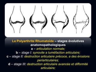 La Polyarthrite Rhumatoïde – stages évolutives
anatomopathologiques
a – articulation normale;
b – stage I: synovite a tuméfaction articulaire;
c – stage II: destruction articulaire précoce, a des érosions
periarticulaires;
d – stage III: destruction articulaire avancée et difformité
articulaire;
 