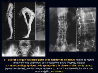 a – aspect clinique et radiologique de la spondylite au début: rigidité de l’epine
vertébrale et le pincement des articulations sacro-iliaques, bilateral
b – aspect radiographique de la spondylite a la phase tardive: ponts osseux
(syndesmophytes) parmi les corps vertébraux, ce qui transforme l’epine dans une
colonne rigide, „en bambou”
 