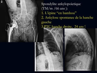 Spondylite ankylopoietique
(TM/m /66 ans ):
1. L’épine “en bambou”
2. Ankylose spontanee de la hanche
gauche
3.PTC hanche droite, 24 ans !
 
